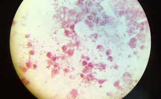 Gonorrea