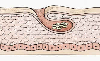 Uova di scabbia sottocutanee